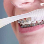 Cepillado de brackets metalicos