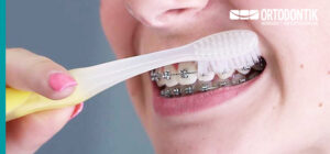 Cepillado de brackets metalicos