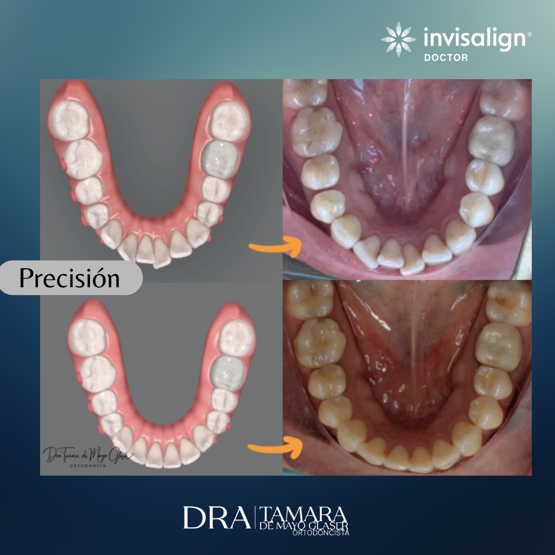 Alineadores  Invisalign