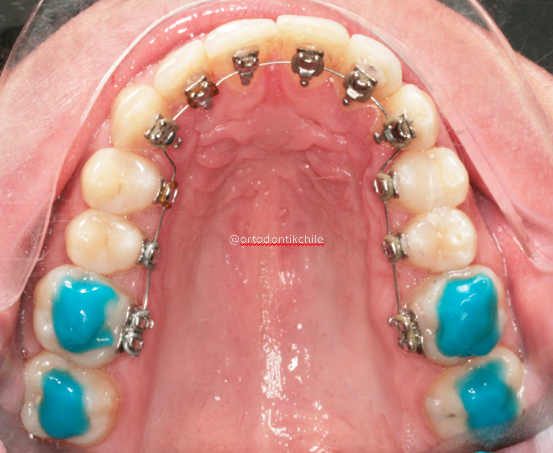 Ortodoncia lingual o Invisalign, cual tratamiento es mejor?