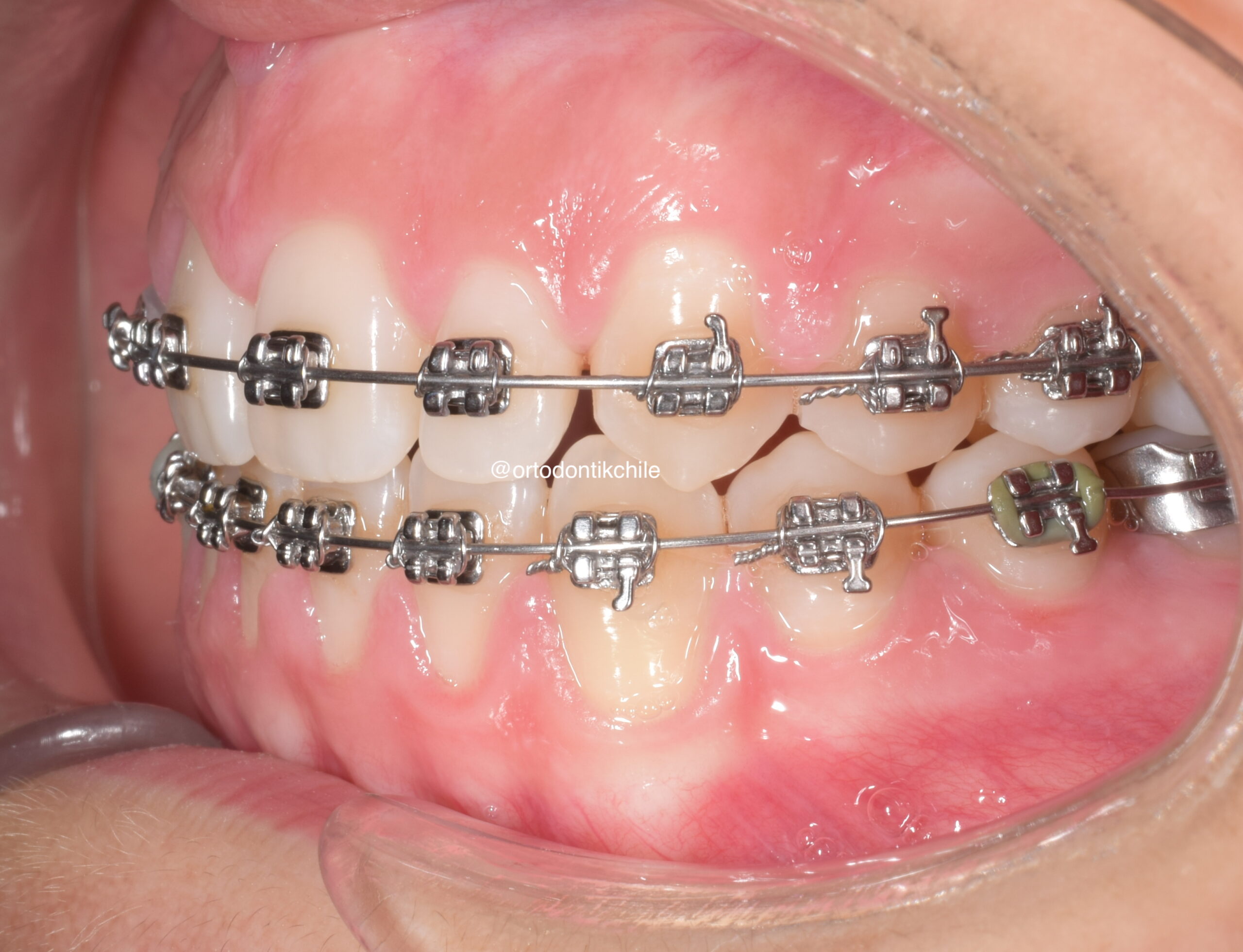 Ortodoncia con brackets metálicos.