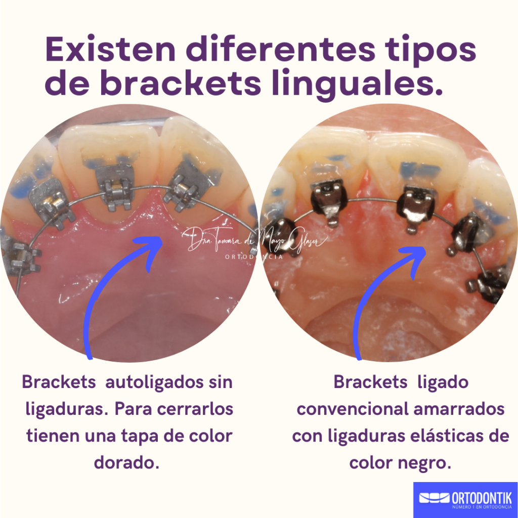 Brackets Autoligado Y Convencional At Matthew Kilburn Blog