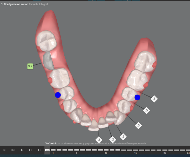 De torcido a confiado: Antes y después de Invisalign