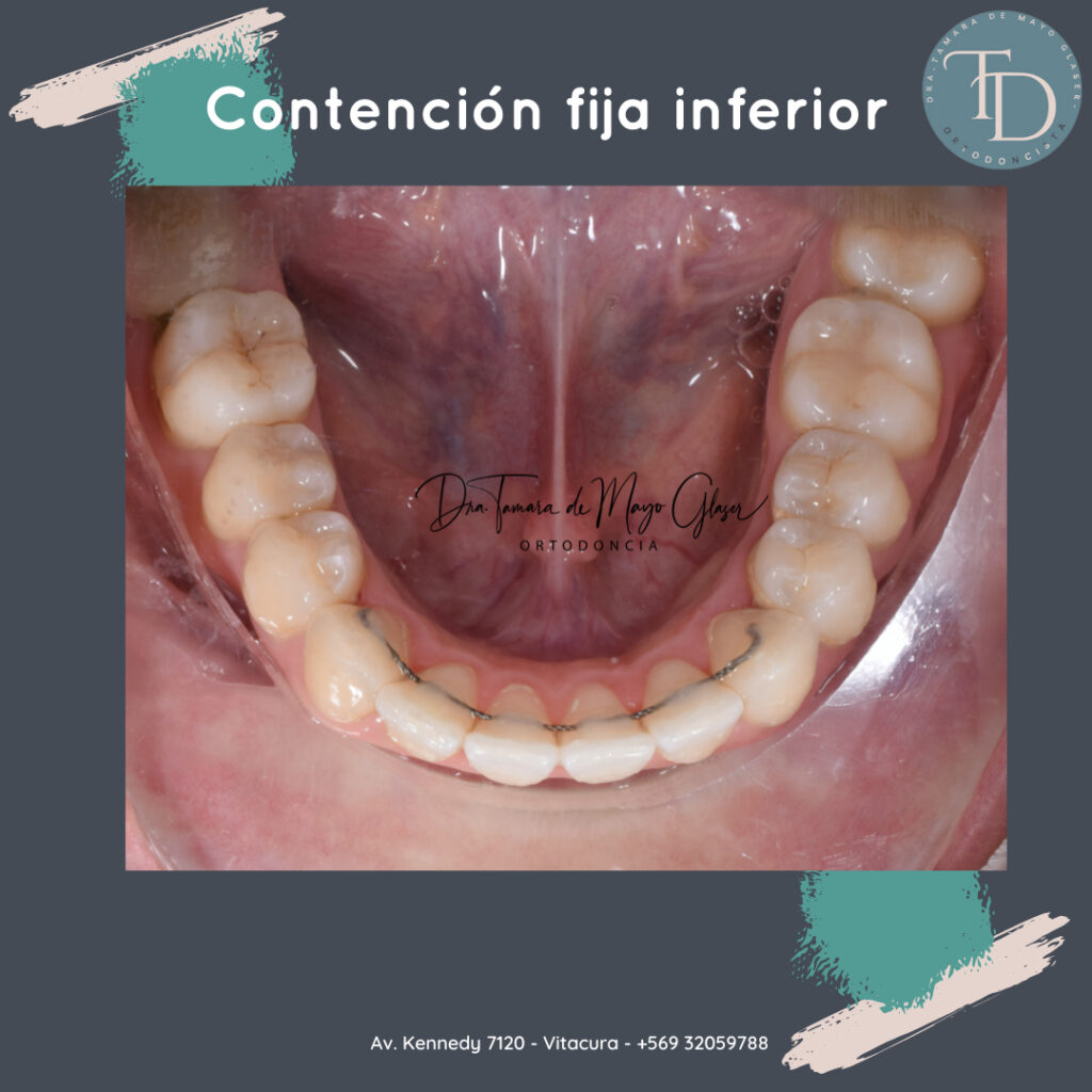 Ortodoncia - Contención fija inferior