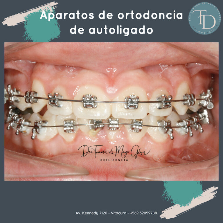 Imagen de boca mostrando todos los dientes con aparatos fijos de autoligado.