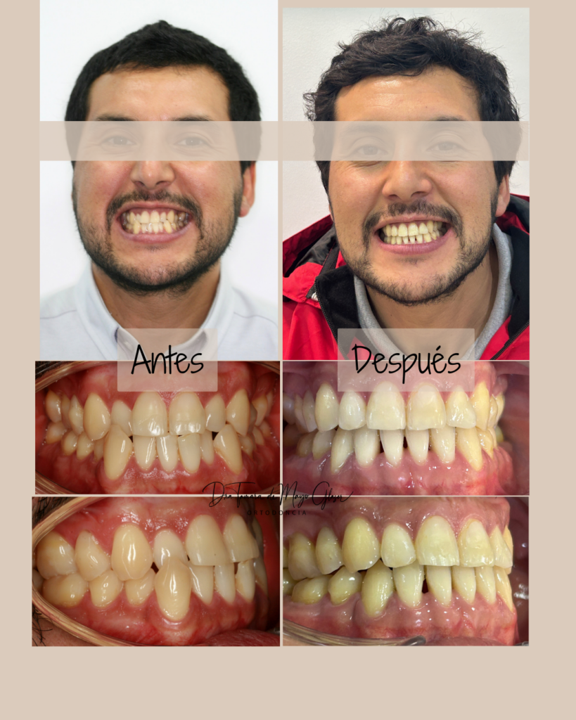 Resultados en paciente adulto antes y después de ortodoncia