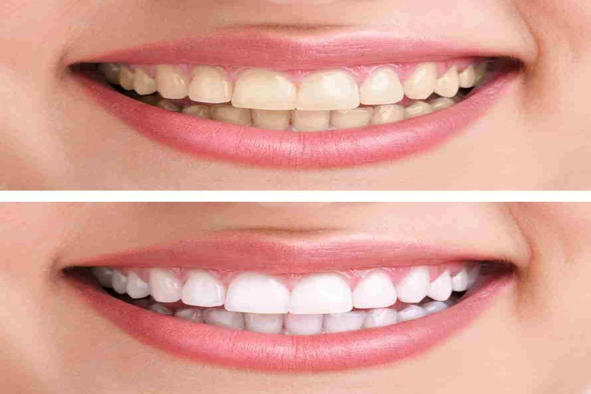Blanqueamiento Dental Huechuraba