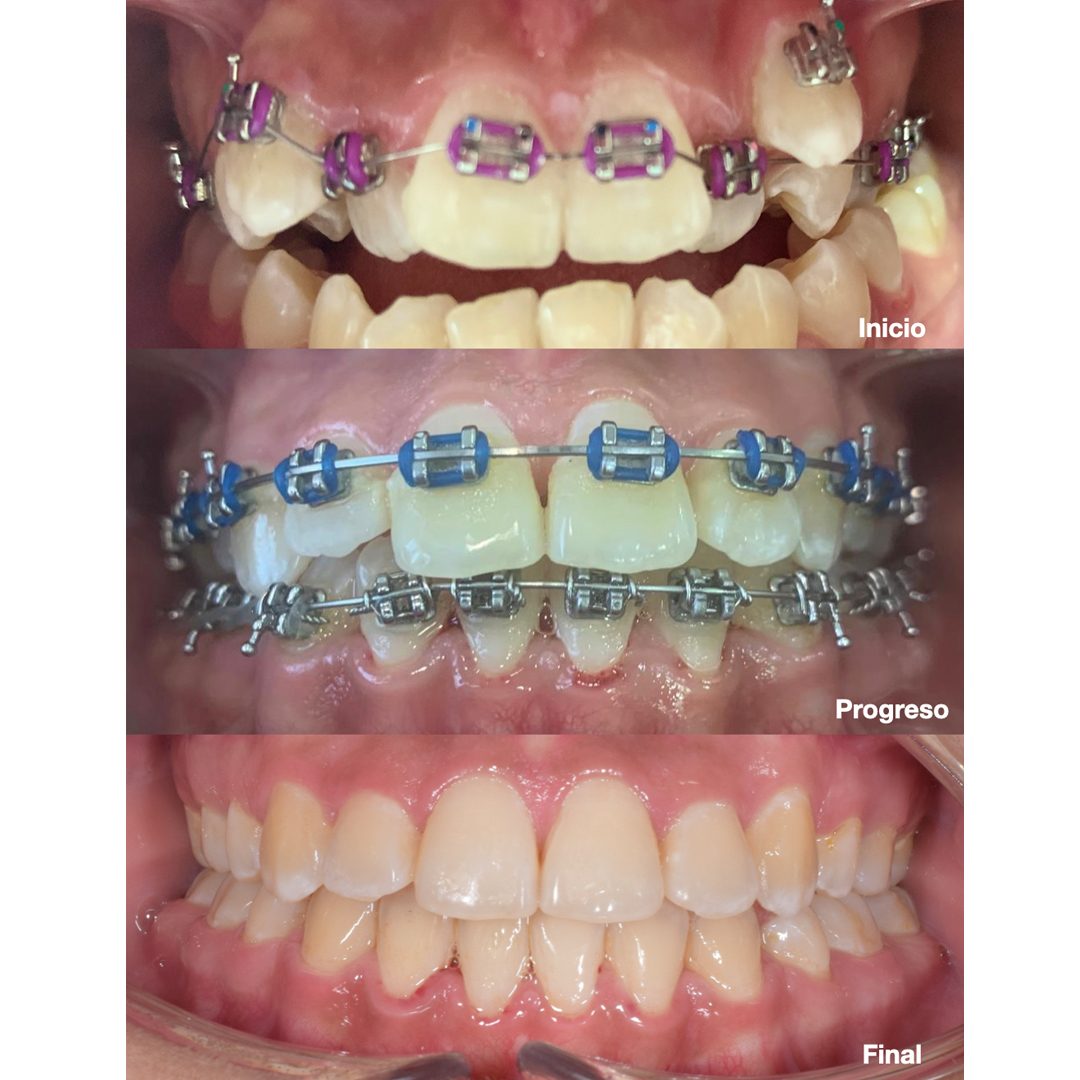 antes y despues de ortodoncia