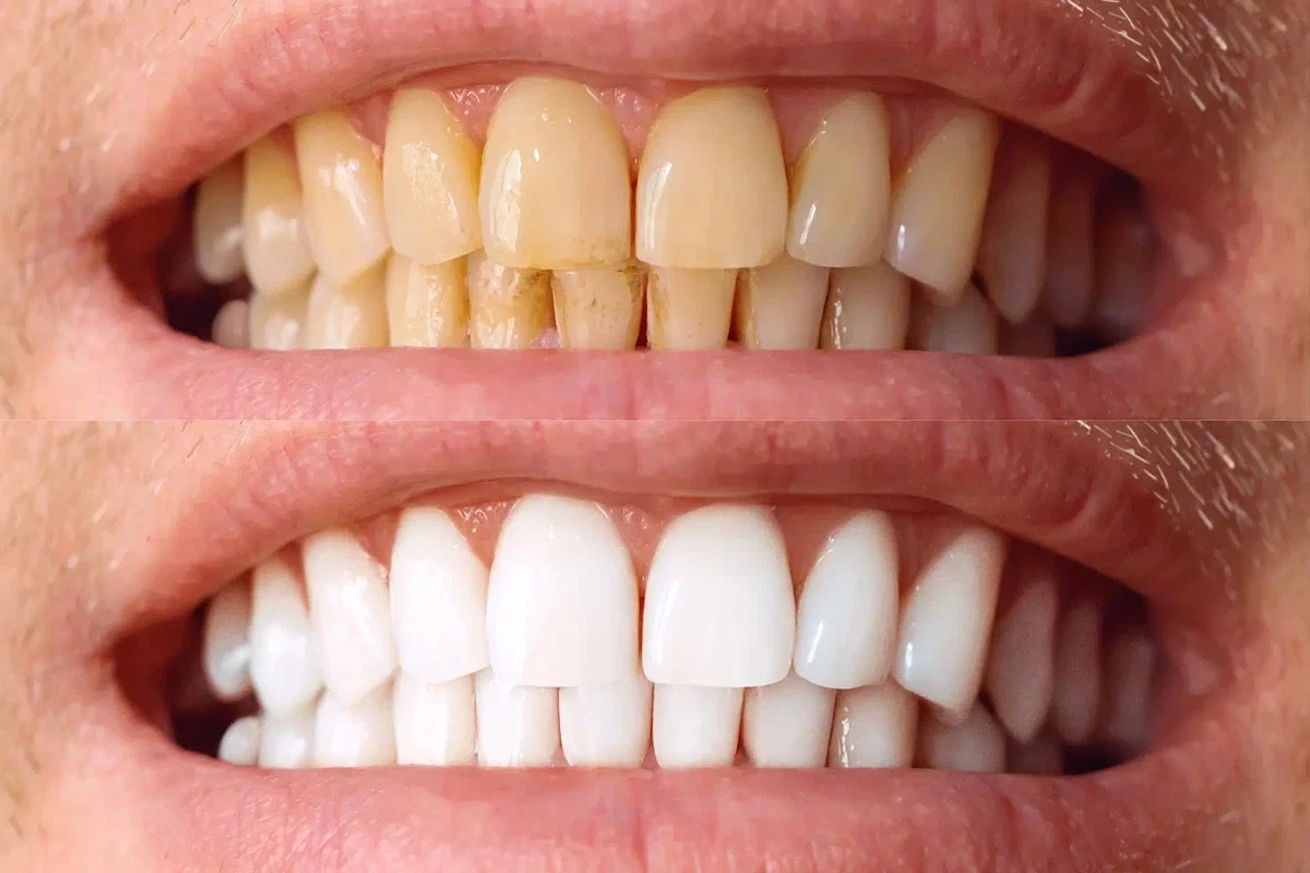 Blanqueamiento Dental Chile Santiago